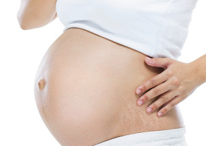 Pregnancy and stretch marks